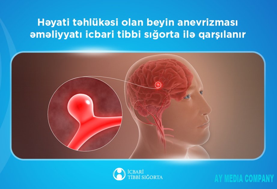 Həyati təhlükəsi olan beyin anevrizması əməliyyatı icbari tibbi sığorta ilə qarşılanır