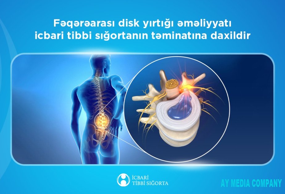 Fəqərəarası disk yırtığı əməliyyatı icbari tibbi sığortanın təminatına daxildir