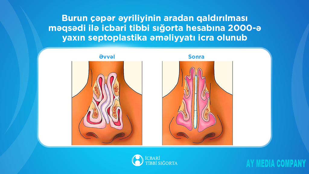 İcbari tibbi sığorta ilə 2000-ə yaxın burun çəpəri əməliyyatı icra olunub